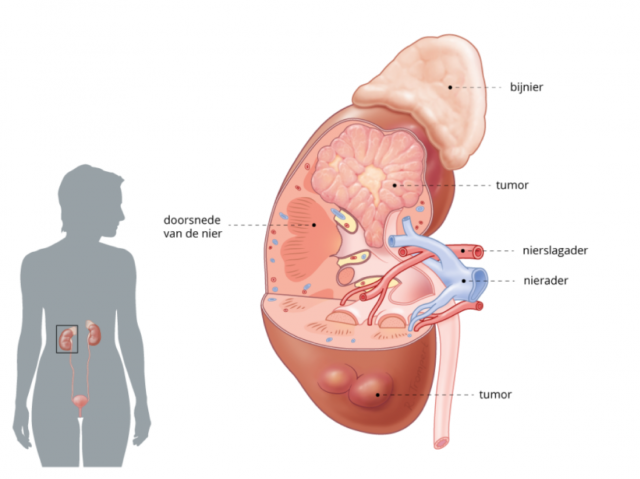 Anatomie van de nier met tumor in de bovenpool