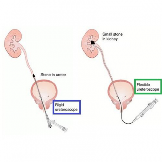 Visualisatie van een rigide versus flexibele ureteroscoop