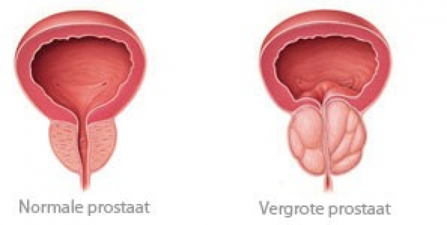 Normale versus vergrote prostaat