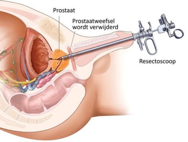 Visualisatie TURP ingreep