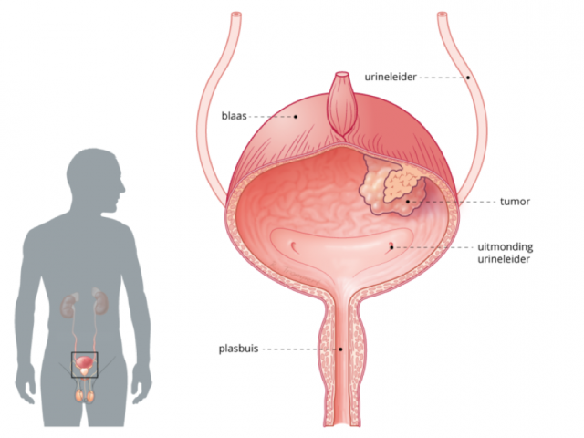 Visualisatie van een tumor in het slijmvlies van de blaas bij blaaskanker.