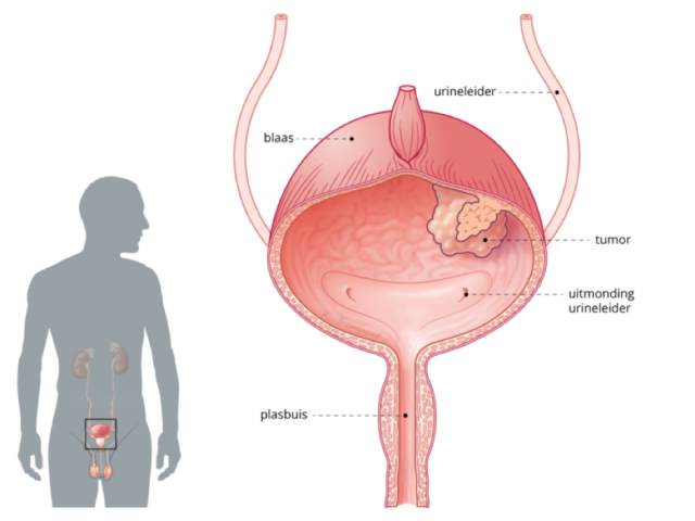 Visualisatie van een tumor in het slijmvlies van de blaas bij blaaskanker. 