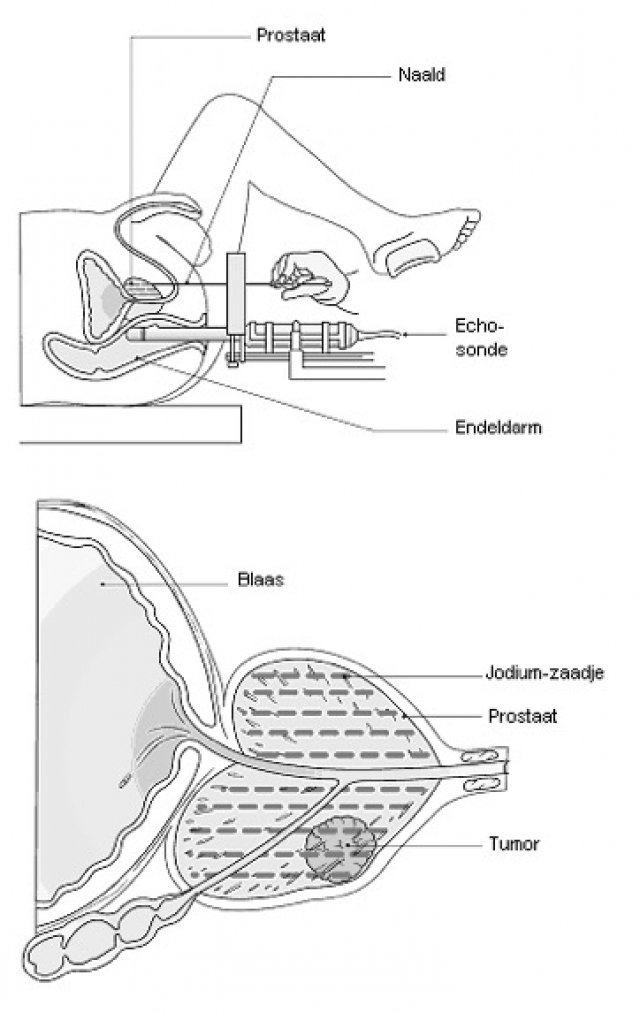 Inwendige bestraling d.m.v. plaatsing radioactief zaadje in de prostaat