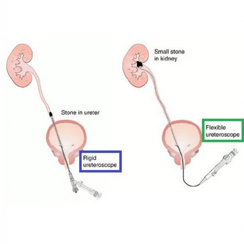 Rigide versus flexibele ureteroscopie
