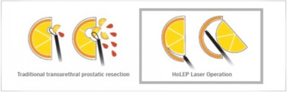 Transvesicale prostatectomie vs Holep